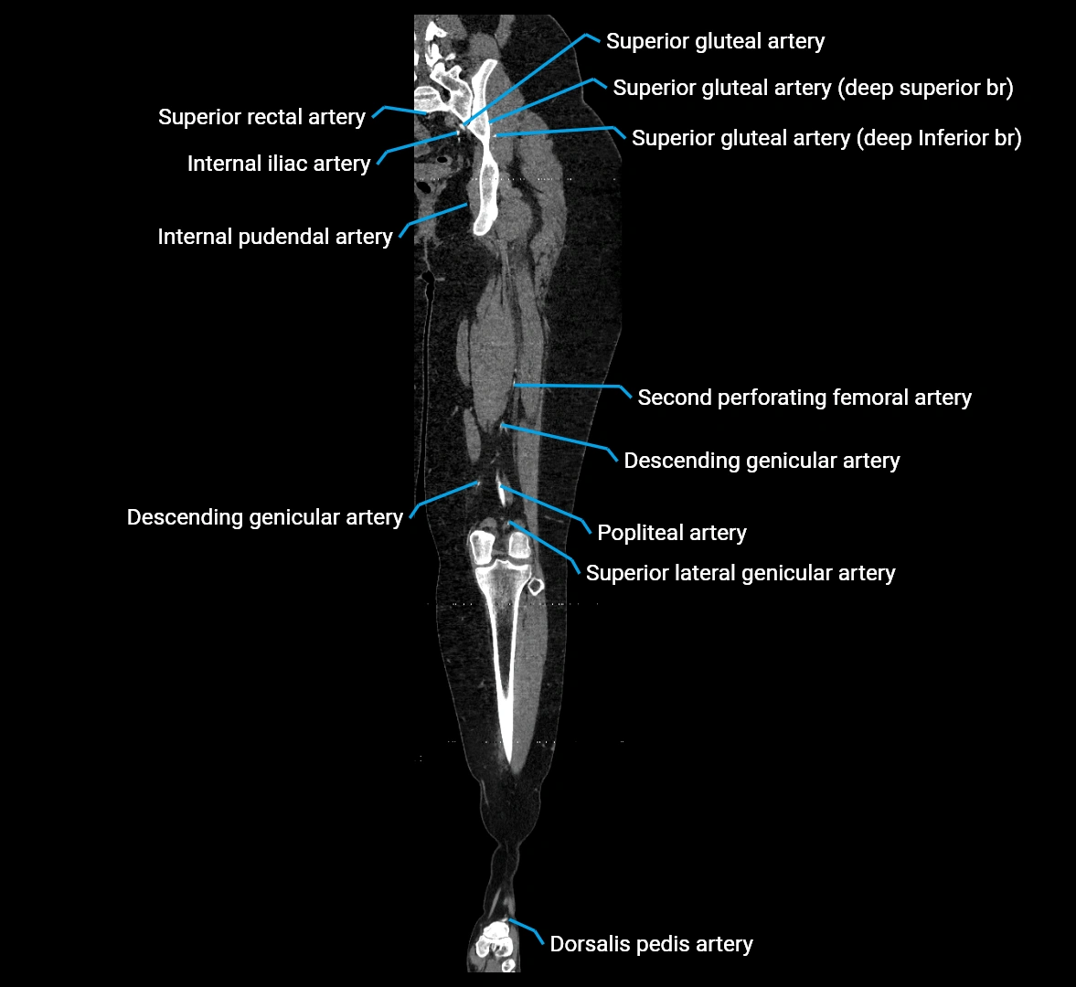 CTA lower limb coronal cross sectional anatomy labelled image _52 (2).webp